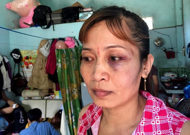 
Bà Dung bị đánh bầm mắt trái, vùng mặt sưng vù. Ảnh: Lê Trai
