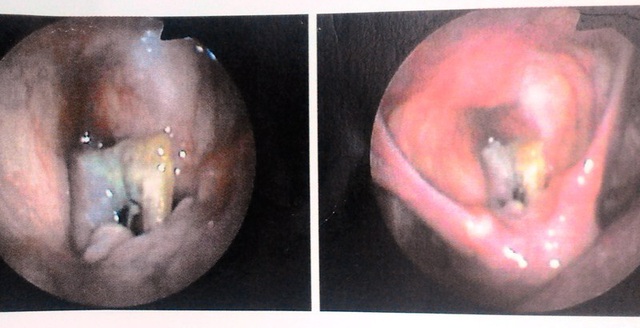 Hình ảnh chụp nội soi cho thấy dị vật khiến cửa thanh quản của bệnh nhân bị bịt kín.
