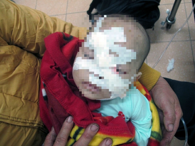 
Ch&aacute;u L. với vết ch&eacute;m tr&ecirc;n mặt. Ảnh: D&acirc;n tr&iacute;
