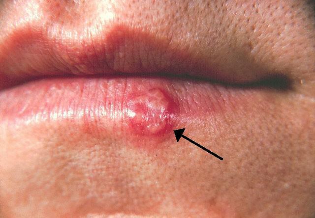 
Virus herpes có thể lây qua dấu hickey - khiến cơ thể suy nhược, môi khô, giảm đề kháng
