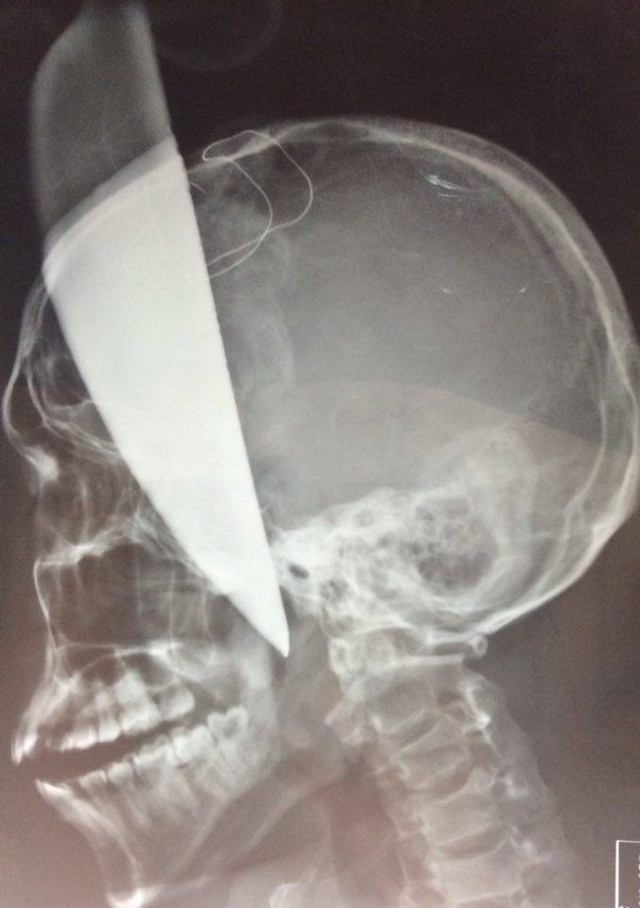 
HÌnh ảnh con dao bầu dài khoảng 40cm cắm sâu vào não bệnh nhân được chụp lại. Ảnh: BVCC
