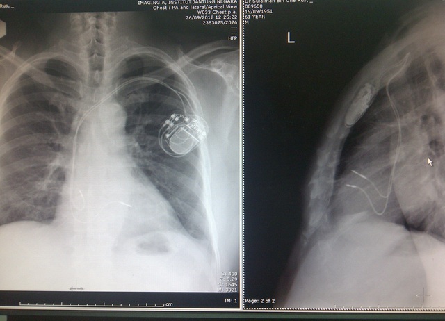 
Hình ảnh X quang bệnh nhân sau cấy máy tạo nhịp 2 buồng. Ảnh: BSCC

