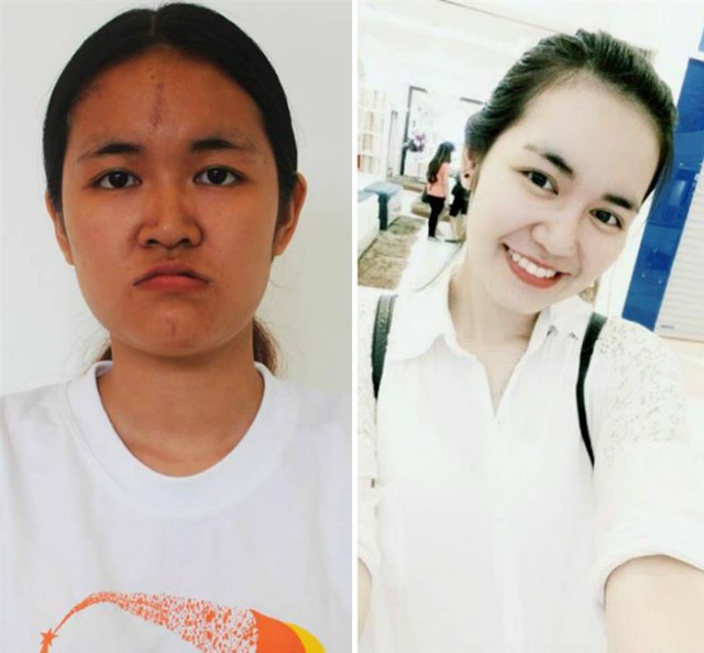 Huyền Trang trước và sau khi phẫu thuật thẩm mỹ. Ảnh: TL