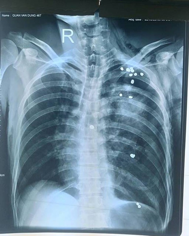 
Hình ảnh chụp X-quang bệnh nhân cho thấy vị trí của gần 20 viên đạn găm khắp người, khắp lồng ngực bệnh nhân. Ảnh: BVCC
