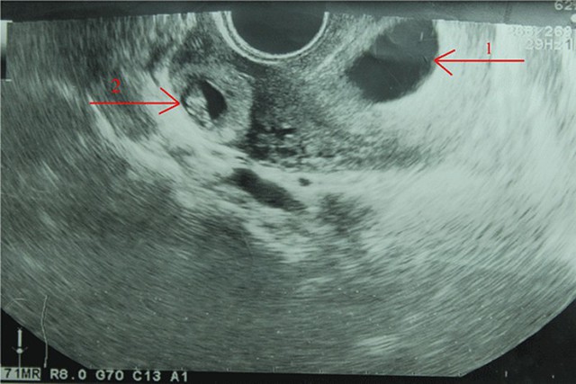 
(1) Hình ảnh túi ối của thai trong tử cung. 2) Hỉnh ảnh thai ngoài tử cung. Ảnh: BVCC
