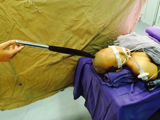 
Chị Lý Thị Thuyên được đưa vào phòng cấp cứu Bệnh viện Đa khoa tỉnh Quảng Ninh với con dao dài dần 1m cắm vào đầu sâu 4cm, dẫn đến chấn thương sọ não hở
