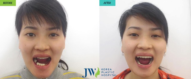 Chị Thu Thảo trước và sau khi thực hiện phẫu thuật hàm móm kết hợp trồng răng sứ tại bệnh viện thẩm mỹ JW