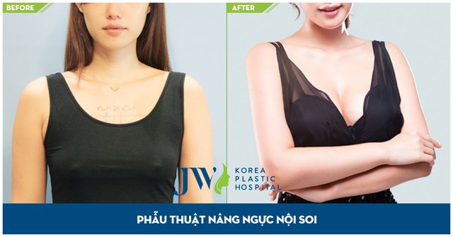 Khách hàng thực hiện nâng ngực bởi TS. BS. Chul Hwan Seul