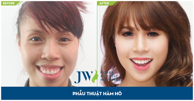 
Lan Nhi trước và sau phẫu thuật hàm hô tại Bệnh viện thẩm mỹ JW Hàn Quốc

