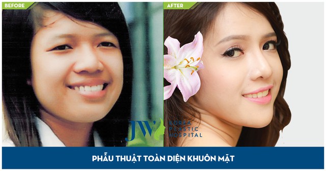 Hình ảnh trước và sau khi phẫu thuật mắt to, nâng mũi S line, gọt mặt V line do TS. BS. Nguyễn Phan Tú Dung thực hiện