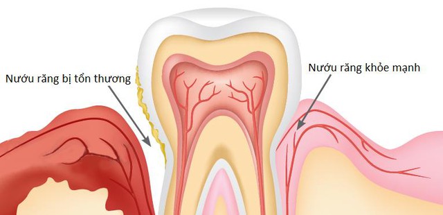 Nướu răng bị tổn thương gây tụt lợi và tiêu xương bao quanh răng
