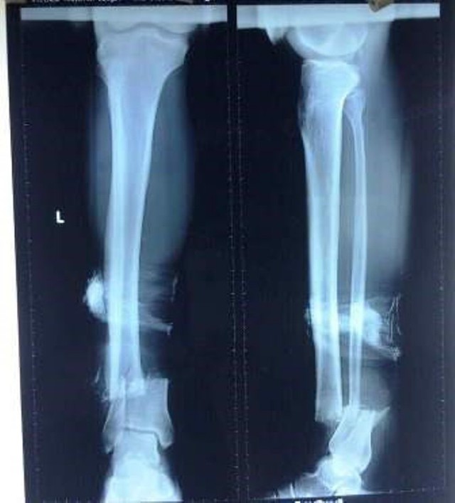 
Hình ảnh chụp XQ, cho thấy cẳng trái của bệnh nhân bị đứt rời chỉ còn dính một ít da. Ảnh: (BVCC)
