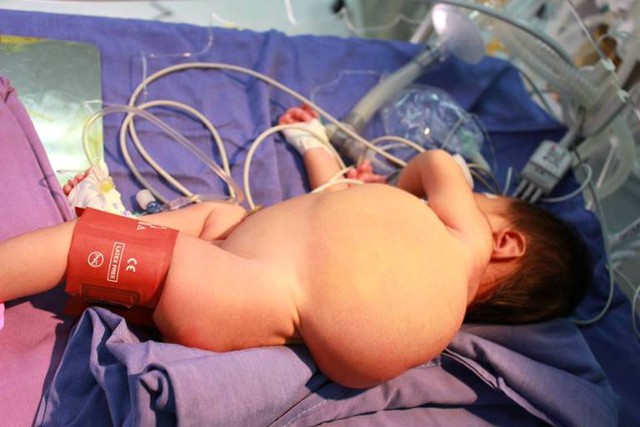 
Khối u của bé Chinh được chẩn đoán trước sinh. Ảnh: Thế Thiêm

