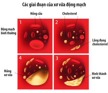 Người gầy đối mặt với rối loạn mỡ máu, cao huyết áp 1