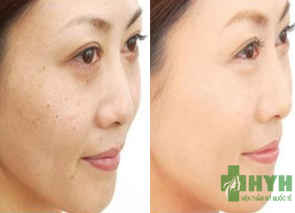 N&aacute;m da &ndash; Kh&ocirc;ng c&ograve;n l&agrave; &aacute;m ảnh của phụ nữ 1