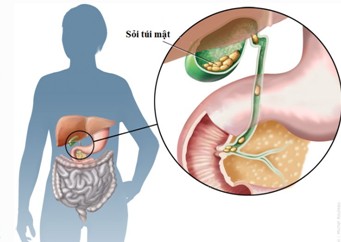 Giữ chi viên sỏi trong túi mật? 1