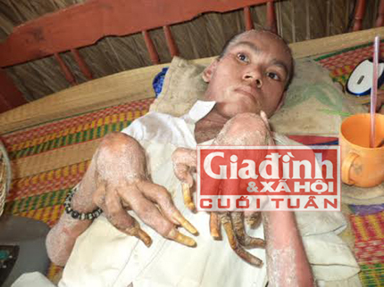 B&aacute;c sĩ x&aacute;c định ch&agrave;ng thanh ni&ecirc;n mắc bệnh h&oacute;a rắn l&agrave; do yếu tố di truyền 1