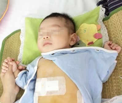 Bệnh nhi 2 tháng tuổi bị phình đại tràng bẩm sinh được phẫu thuật thành công nhờ nội soi bằng robot 1