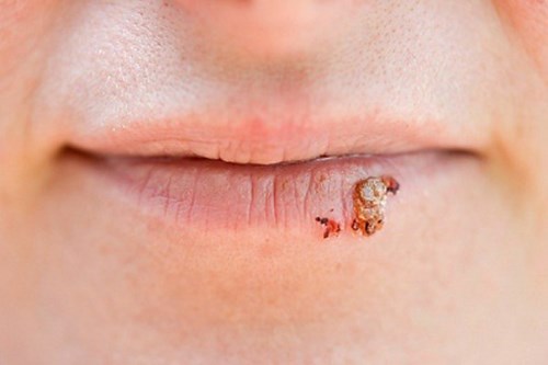 Sởn da g&agrave; những h&igrave;nh ảnh bệnh l&acirc;y qua đường t&igrave;nh dục 10