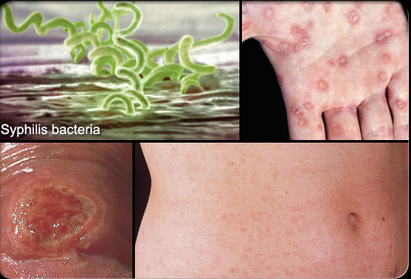 Sởn da g&agrave; những h&igrave;nh ảnh bệnh l&acirc;y qua đường t&igrave;nh dục 1