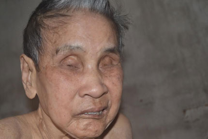 Cuộc sống cùng cực của cụ bà 82 tuổi mù hai mắt, nằm liệt giường 1