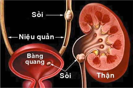 Bệnh sỏi thận: Chớ coi thường  1