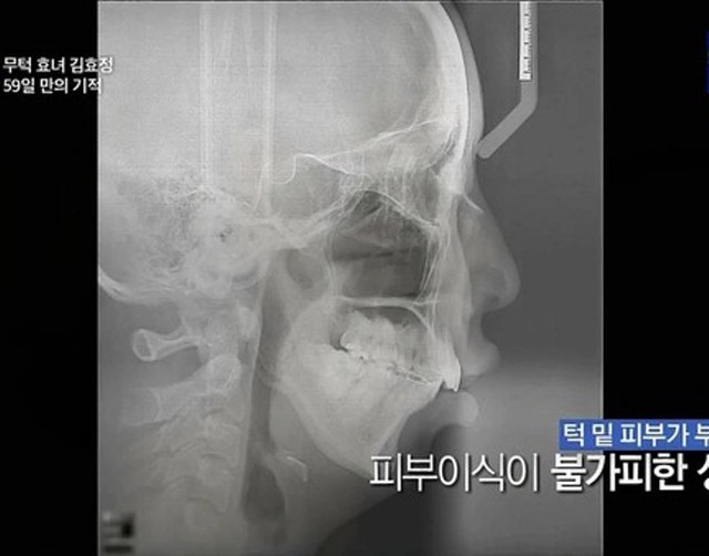 Phần cằm của Kim Hyo Jeong gần như không có và hàm răng lại rất yếu ớt. Mặc dù đã được các bác sĩ tư vấn về những rủi ro có thể gặp phải nhưng cô gái trẻ vẫn quyết định thực hiện phẫu thuật.