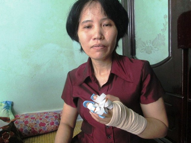 Bà Hà Thị Tú bị chém lìa hai ngón tay. Ảnh: T.D