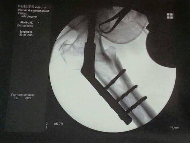 Thiết bị C-ARM giúp ê-kíp phẫu thuật mổ thầm nhờ nhìn xuyên qua da thịt.