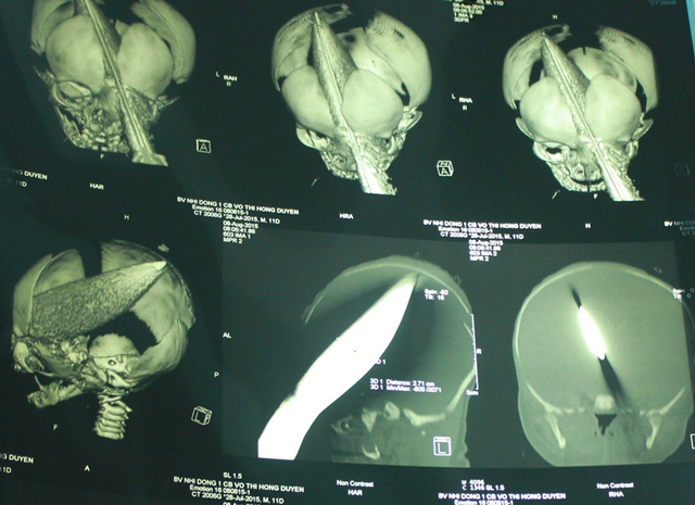 Kết quả CT-Scan cho thấy lưỡi dao tàn nhẫn cắm ngập đầu bé sơ sinh 11 ngày tuổi.