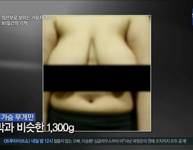 Các chuyên gia nhận xét trường hợp của Ho Jeong là trường hợp khó khăn nhất về vòng 1 từ trước đến nay của chương trình Let’s Beauty. Phần xương cột sống của Ho Jeong bị tổn thương do chịu sức nặng của vòng một khiến cô luôn cảm thấy đau mỏi lưng
