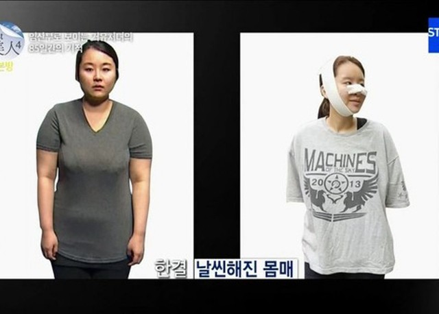 Hình ảnh trước và sau khi phẫu thuật thẩm mỹ của cô. Trước đó, cô từng sở hữu thân hình đồ sộ với cân nặng 78kg và dù đi đâu, cô cũng đều dùng vải nịt quấn quanh ngực với hi vọng phần nào đó giảm bớt được kích cỡ vòng 1