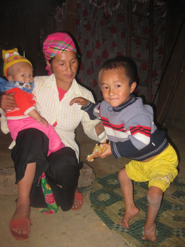 Bé Vàng A Ý (xã Nậm Xé, huyện Văn Bàn, Lào Cai) năm nay 8 tuổi, bị bệnh khoèo chân từ lúc mới sinh. Việc chữa trị rất khó khăn vì bé điều trị quá muộn.  	ảnh: V.T