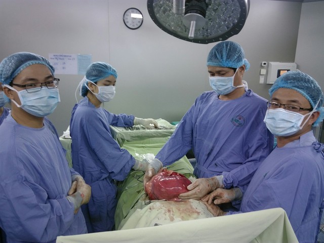 Các bác sĩ khoa Tiêu hóa (Bệnh viện Ung thư Đà Nẵng) đã phẫu thuật thành công lấy khối u khổng lồ ra khỏi cơ thể bệnh nhân.