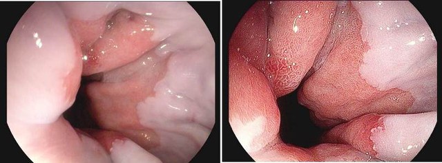 T&iacute;nh năng hai m&agrave;n h&igrave;nh hiển thị c&ugrave;ng chương tr&igrave;nh xử l&yacute; ảnh I-Scan gi&uacute;p kết quả nội soi r&otilde; r&agrave;ng hơn nhiều lần, đồng thời tại c&ugrave;ng thời điểm c&oacute; thể gi&uacute;p b&aacute;c sĩ so s&aacute;nh đ&aacute;nh gi&aacute;, chẩn đo&aacute;n bệnh l&yacute; tốt hơn