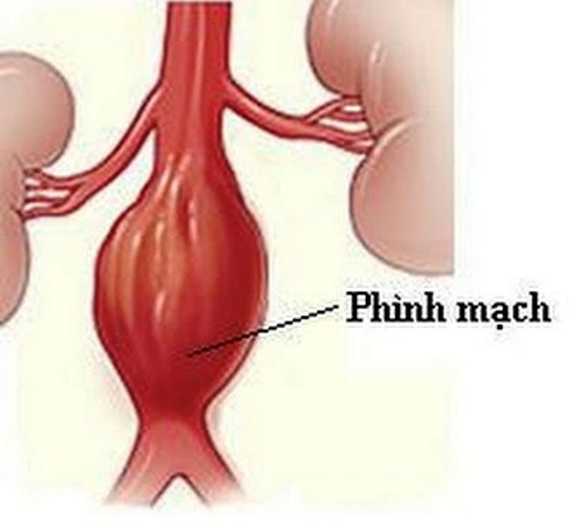 Chuyên gia nói phình động mạch chủ là bệnh lý diễn tiến âm thầm nhưng nguy hiểm chết người khi phát hiện quá muộn.