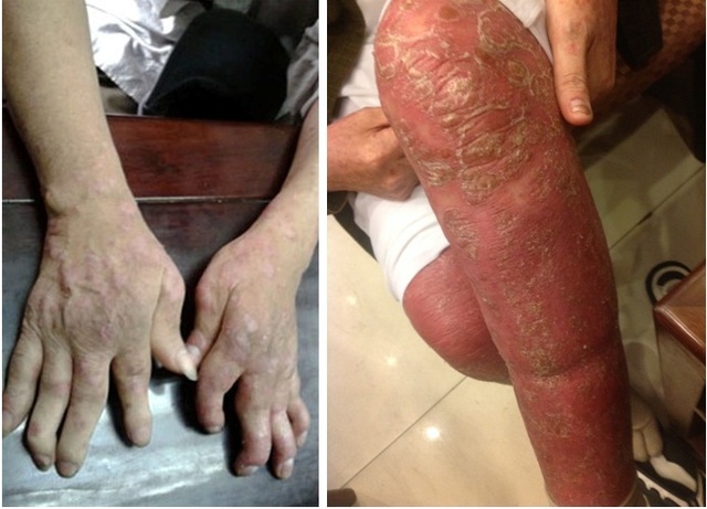 Bệnh vẩy nến kh&ocirc;ng ph&aacute;t hiện v&agrave; điều trị kịp thời bệnh sẽ loang to&agrave;n th&acirc;n v&agrave; g&acirc;y ra nhiều biến chứng.