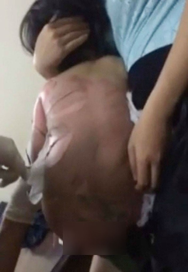 
Hình ảnh bé Quỳnh Trang khi mới bị bỏng. Ảnh: Nguyễn Hùng Sơn

 
