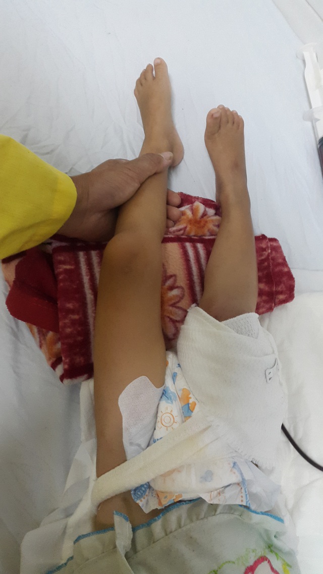 
Hai chân của bé đã bị lệch nhau do chân phải bị cắt bỏ một phần xương hoại tử. Ảnh P.Thuận
