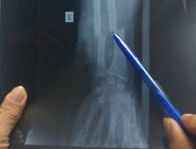 
Hình ảnh chụp X-quang cho thấy bàn tay người đàn ông bị đứt lìa. Ảnh: Hoài Nhơn.
