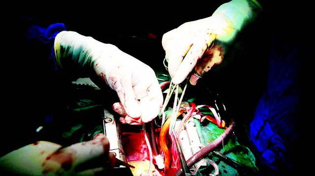 Một ca phẫu thuật tim hở tại BVĐK Quảng Ninh. Ảnh: Xuân Vinh