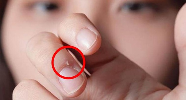 
Xước măng-rô có thể hủy hoại ngón tay của cả người lớn và trẻ em (Ảnh: Internet)
