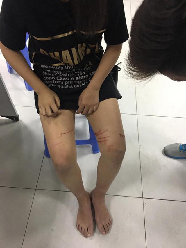 C&ocirc; g&aacute;i tố bị kẻ biến th&aacute;i cứa nhiều vết ở ch&acirc;n