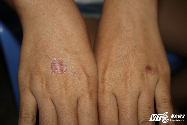 
Hai vết sẹo tr&ecirc;n tay T. U do bị đối tượng Nh&iacute; Tin&ocirc; d&ugrave;ng thuốc l&aacute; đang ch&aacute;y ch&acirc;m v&agrave;o.
