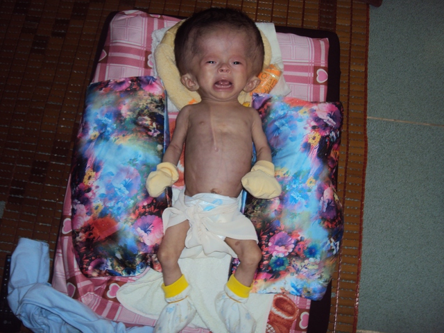 
Mới 3 tháng tuổi Bảo Anh đã phải chịu nỗi đau của bệnh não úng thủy
