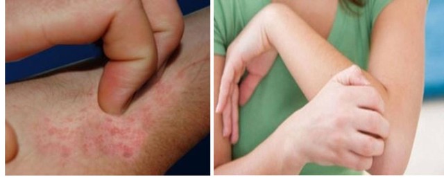 
Người da khô khi tiếp xúc với hoá chất cần đi găng tay bảo vệ da.
