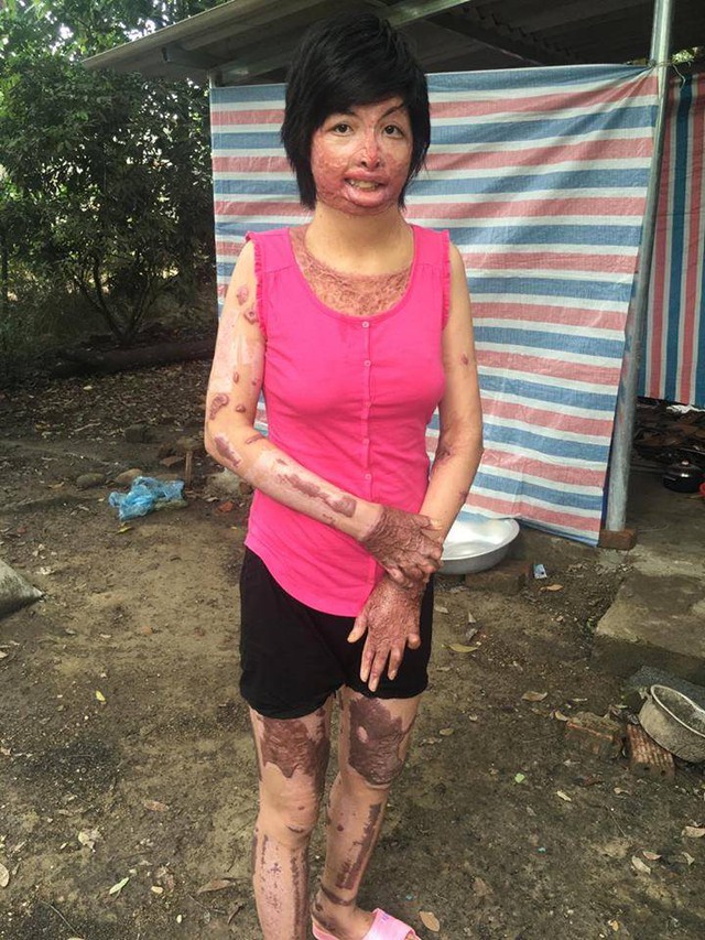 
Chị Hoàng Thị Trang sau khi gặp nạn.
