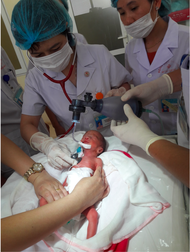 
Cuối tháng 7/2017, BVĐK Mộc Châu đã thực hiện thành công kĩ thuật bơm surfactant điều trị bệnh màng trong cho trẻ sơ sinh non tháng suy hô hấp. Ảnh: BVCC
