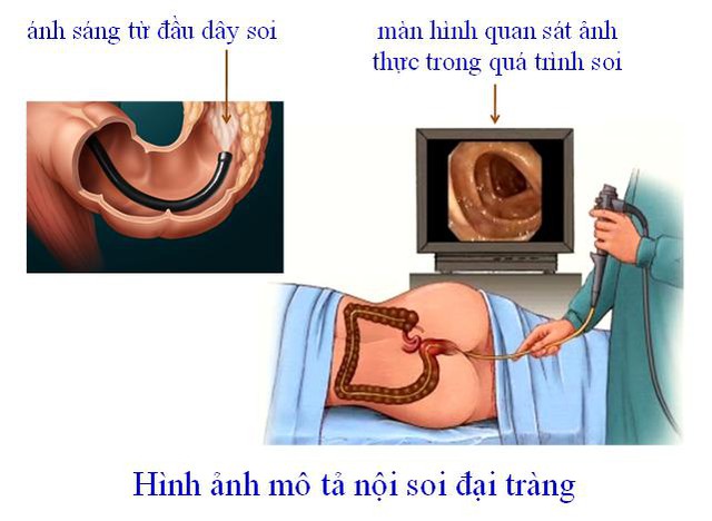 Nên đi sàng lọc nội soi đại tràng để phát hiện sớm bệnh. Ảnh: T.L