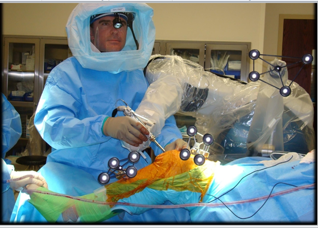 
Cánh tay Robot hỗ trợ và đem lại sự thoải mái, thuận lợi cho phẫu thuật viên trong suốt quá trình phẫu thuật. Ảnh: BVCC
